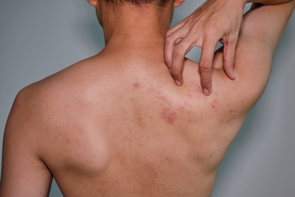 acne mechanica or friction acne causes and treatment