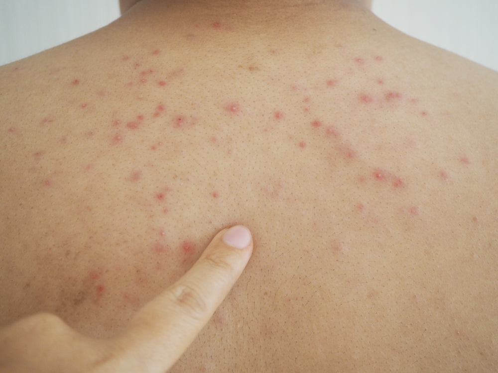 what is sweat acne and how do I prevent it