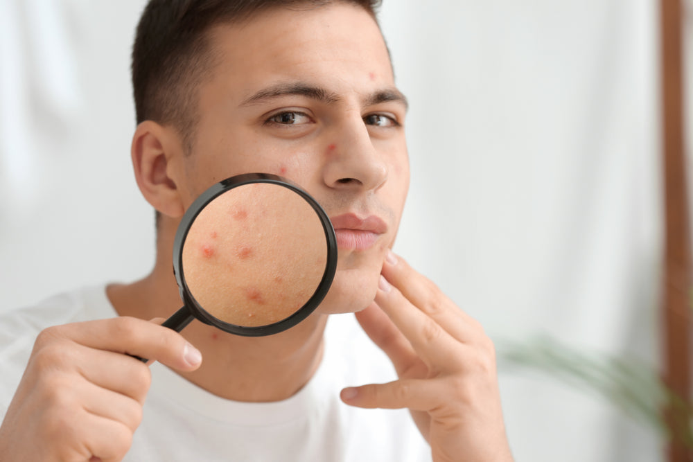 Understanding Acne In Men: Causes, Treatment and Prevention