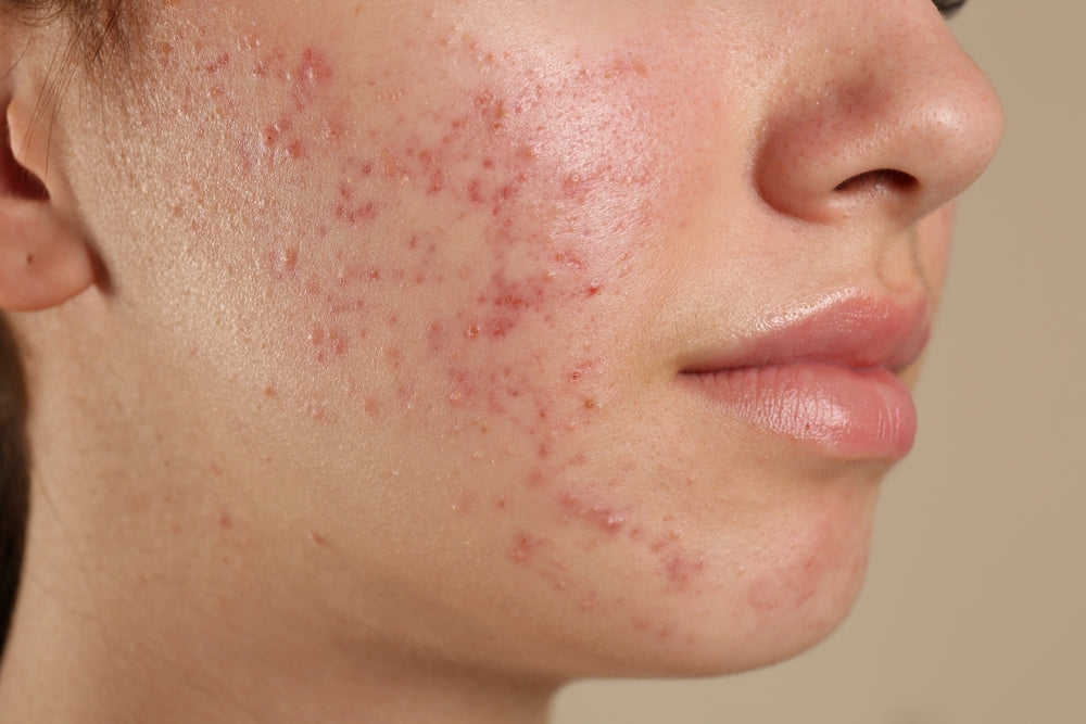 causes of acne on one side of the face