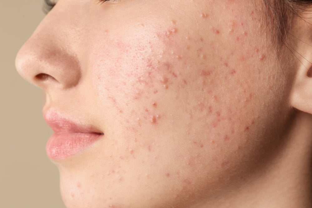 causes of acne during menopause