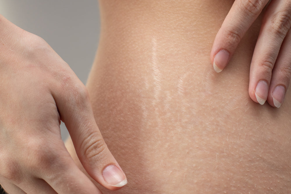 How Pregnancy Affects Your SKin